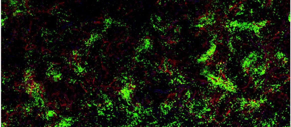 Haemophilia A Becker-Gotot