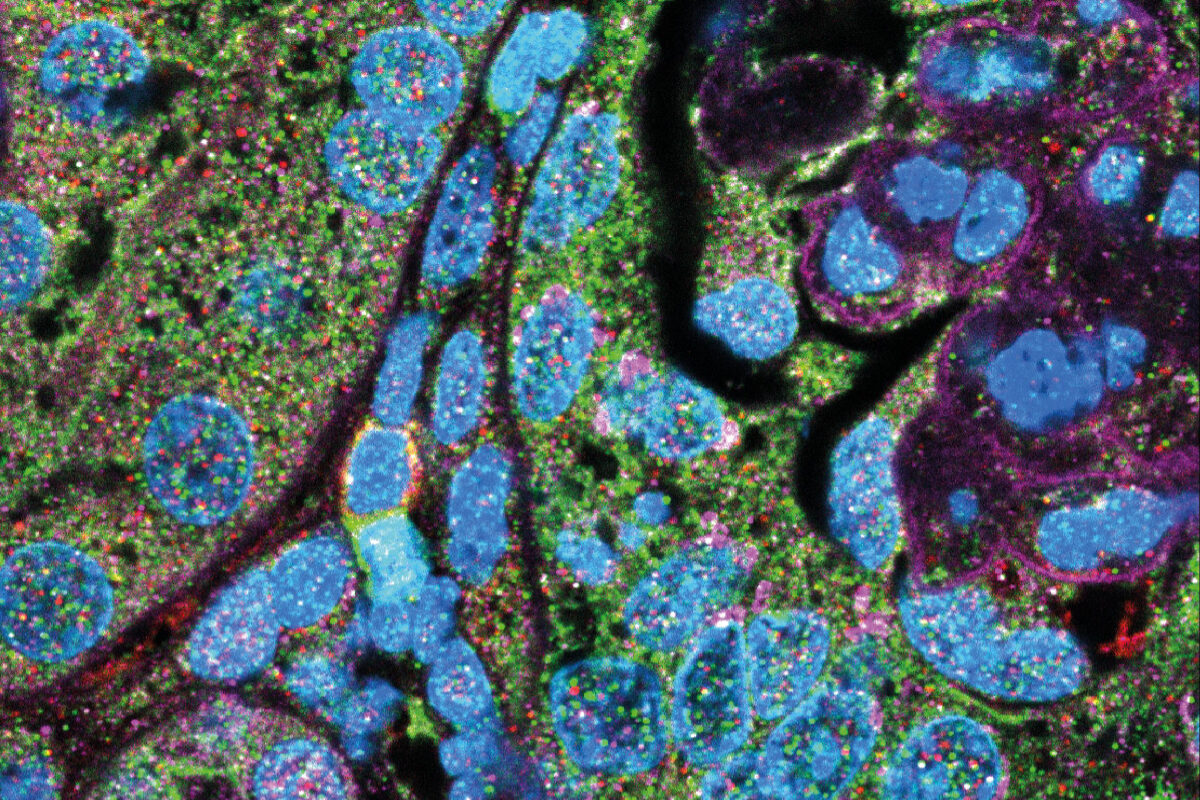 Immunofluorescence staining of MAIT cells (green) next to mononuclear phagocytes (red) in kidney sections of mice with experimental glomerulonephritis. Cell nuclei in blue. Image: Nature Communications, DOI: 10.1038/s41467-023-43269-0