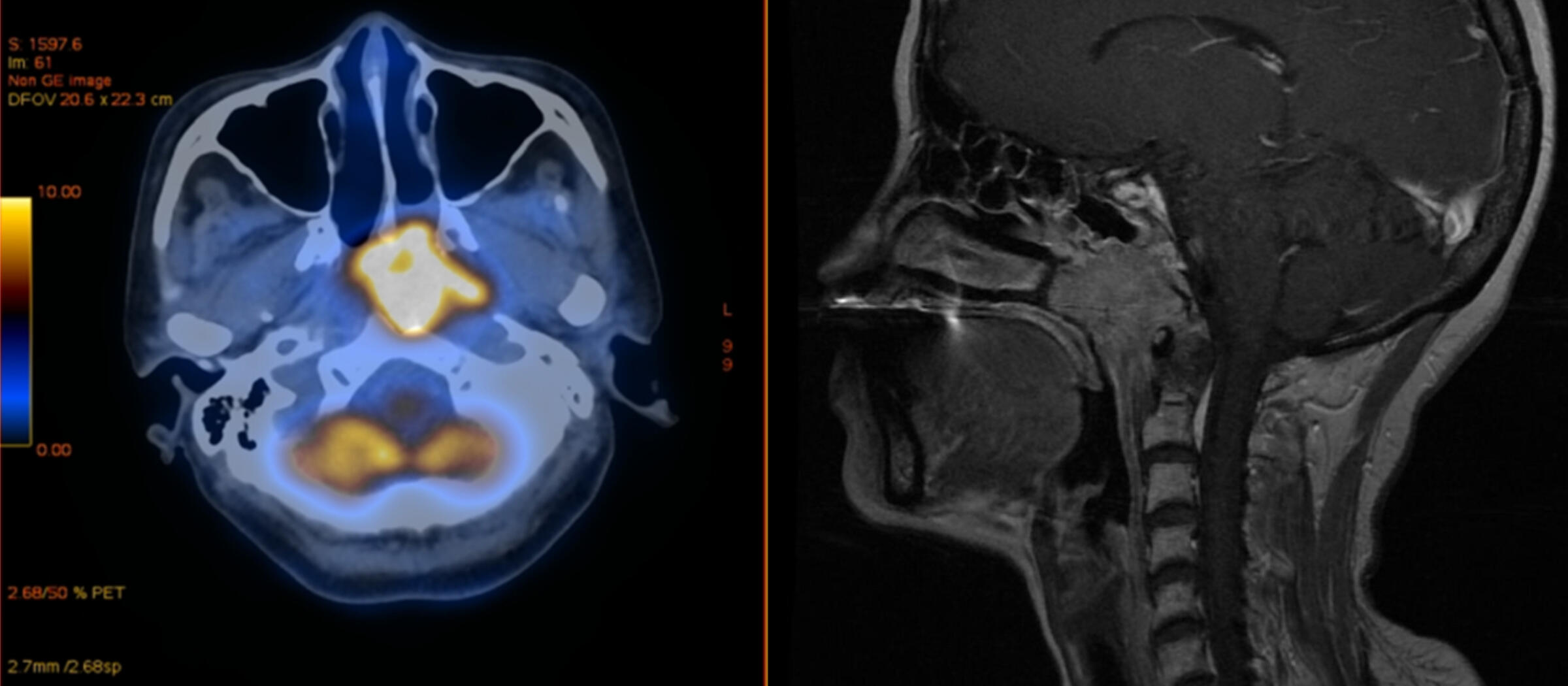 IMMEI Covid Vaccination Cancer