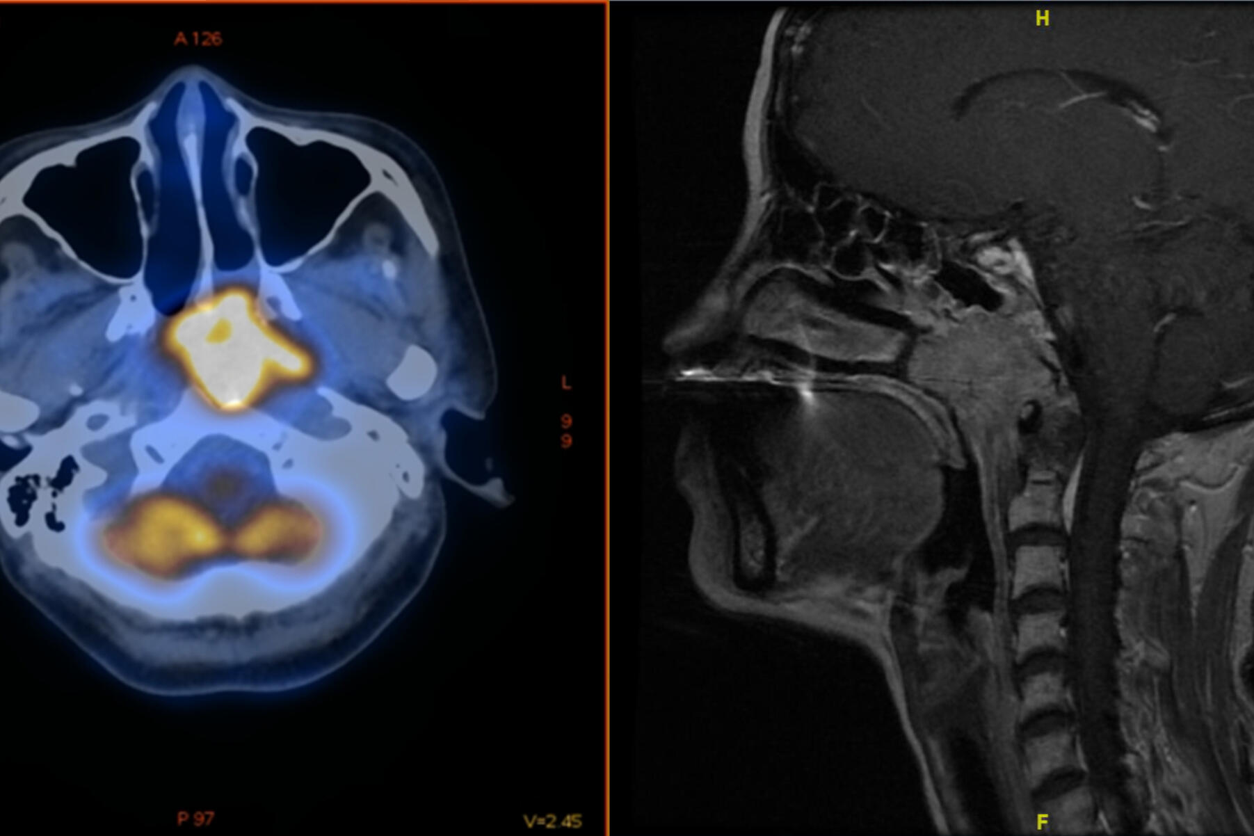 IMMEI Covid Vaccination Cancer